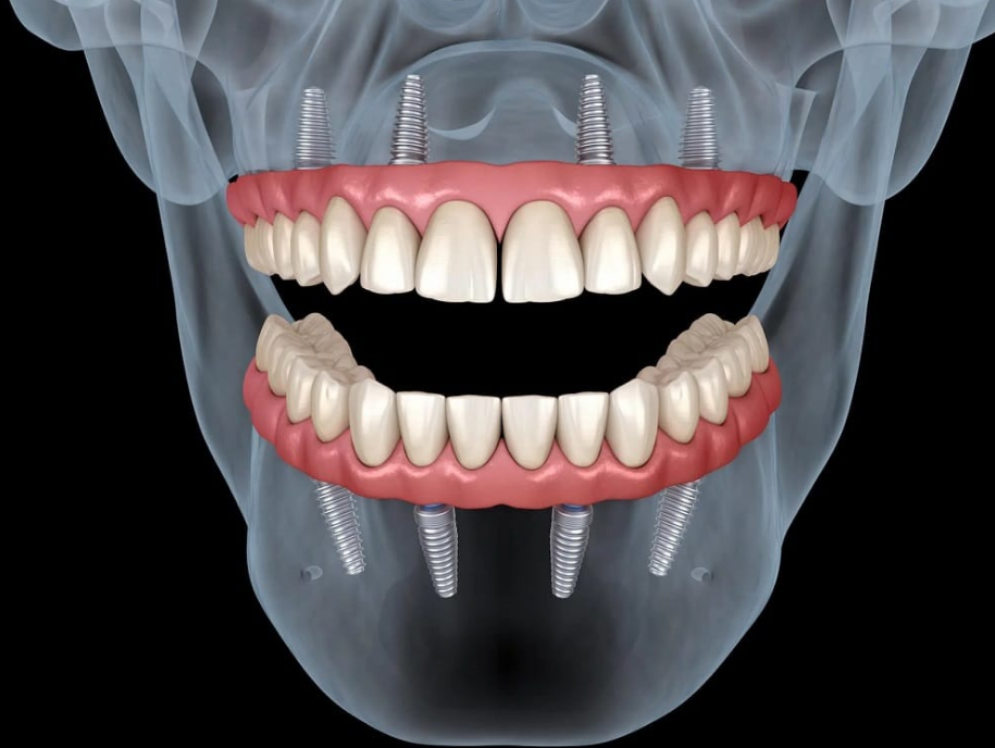 Procedura de implant dentar informatii esentiale pentru tine