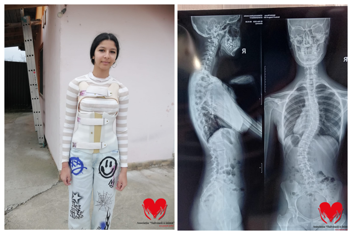 Erika are doar 15 ani si are nevoie urgenta de ajutorul vostru Fiecare zi imi afecteaza coloana Vreau sa merg la scoala Oparatia este sansa mea